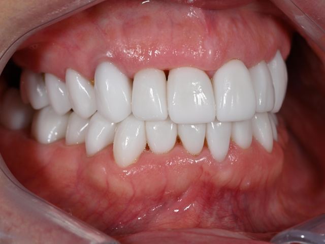 Smile makeover patient smile after treatment