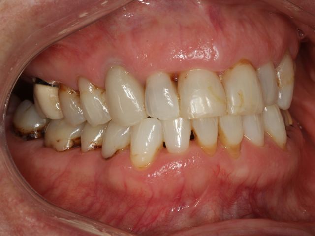 Smile makeover patient smile before treatment