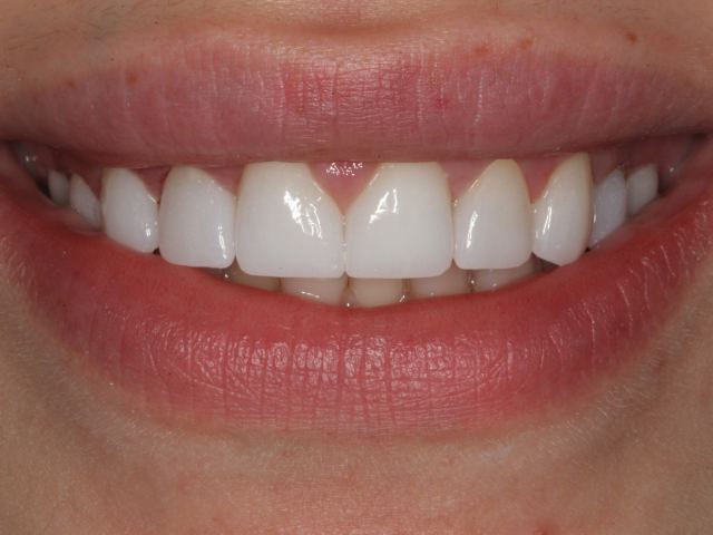 Cosmetic veneers patient smile after treatment