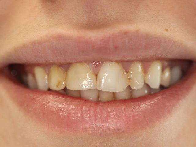 Cosmetic veneers patient smile before treatment