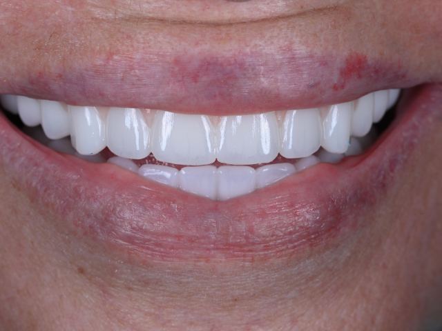 All-on-X implants patient smile after treatment