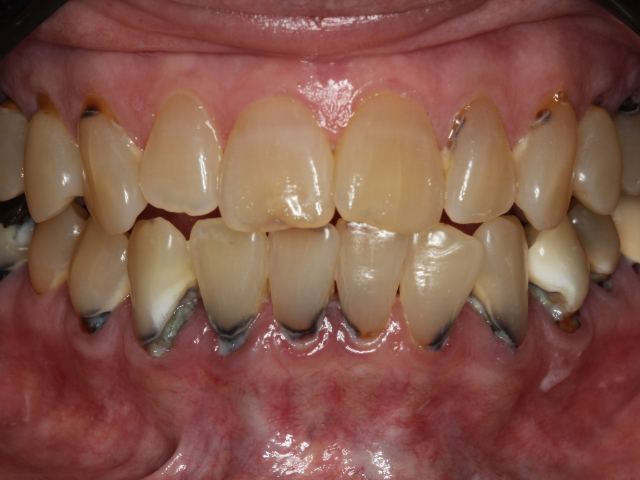 All-on-X implants patient smile before treatment