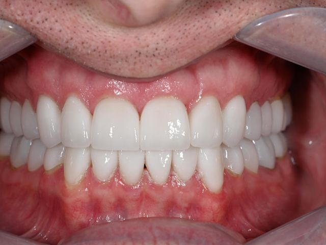 Full mouth rejuvenation patient smile after treatment
