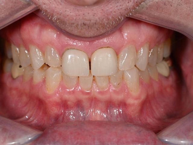 Full mouth rejuvenation patient smile before treatment