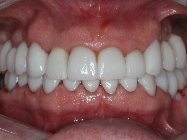 Full mouth restoration patient smile after treatment
