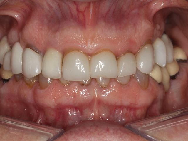 Full mouth restoration patient smile before treatment