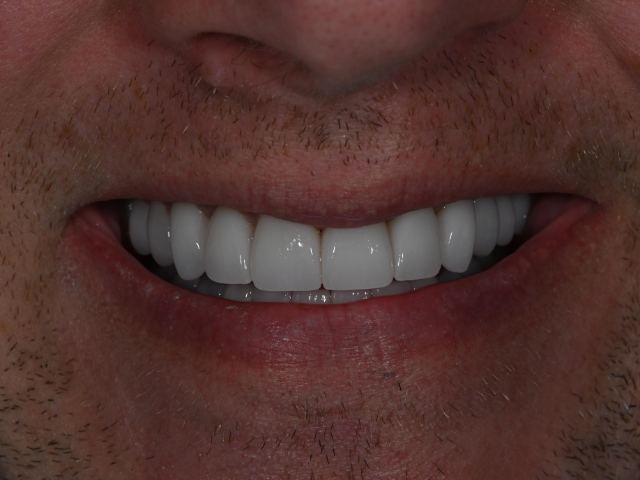 Smile makeover patient smile after treatment