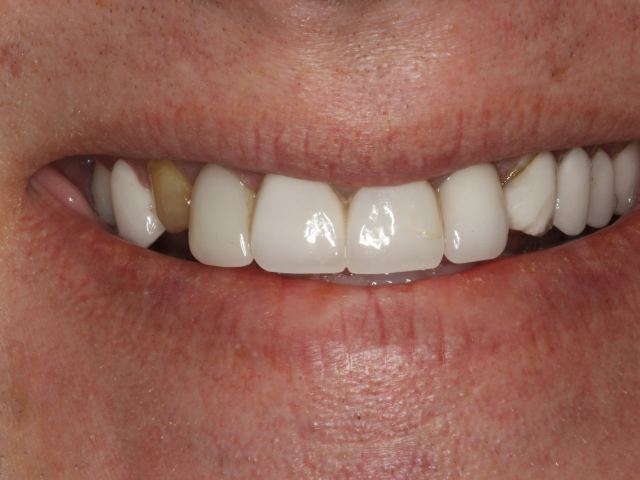 Smile makeover patient smile before treatment